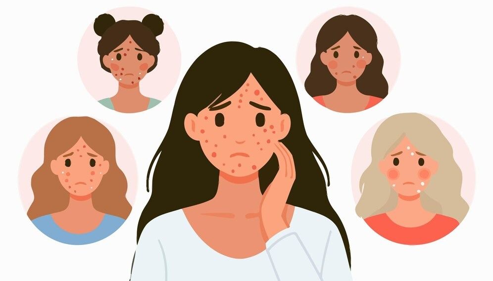 Acne Myths Dermatologists Want You to Stop Believing