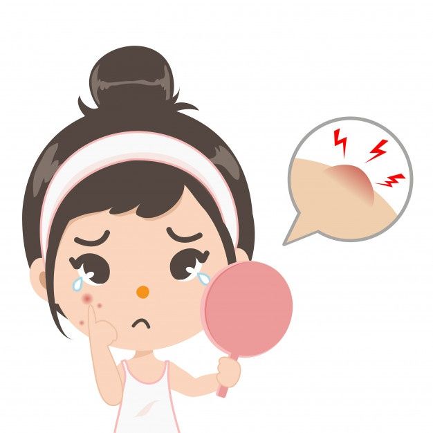 How to Treat Acne in Kids and Teens – What Experts Says