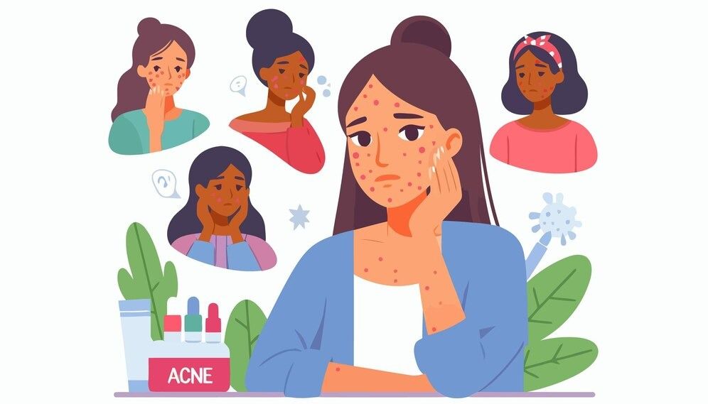 Is Acne Genetic or Environmental? – Dermatology Sense