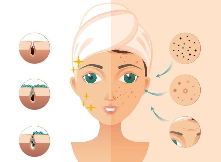 What Causes Acne? – DermatologySense.com