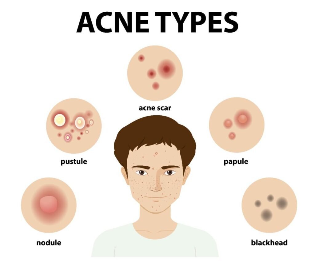 Types of Acne