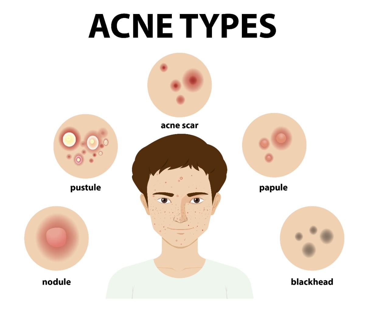 Types of Acne: Blackheads, Whiteheads, Cysts & More